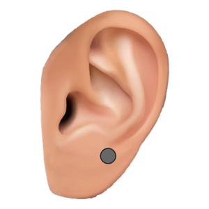 アッパーロブ(Upper Lobe)